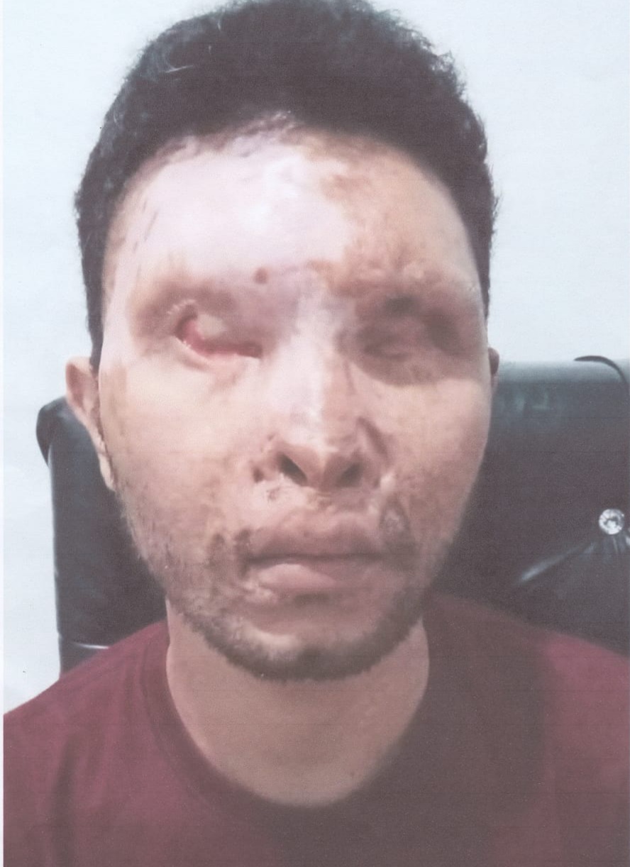 Chandra korban penyiraman air keras